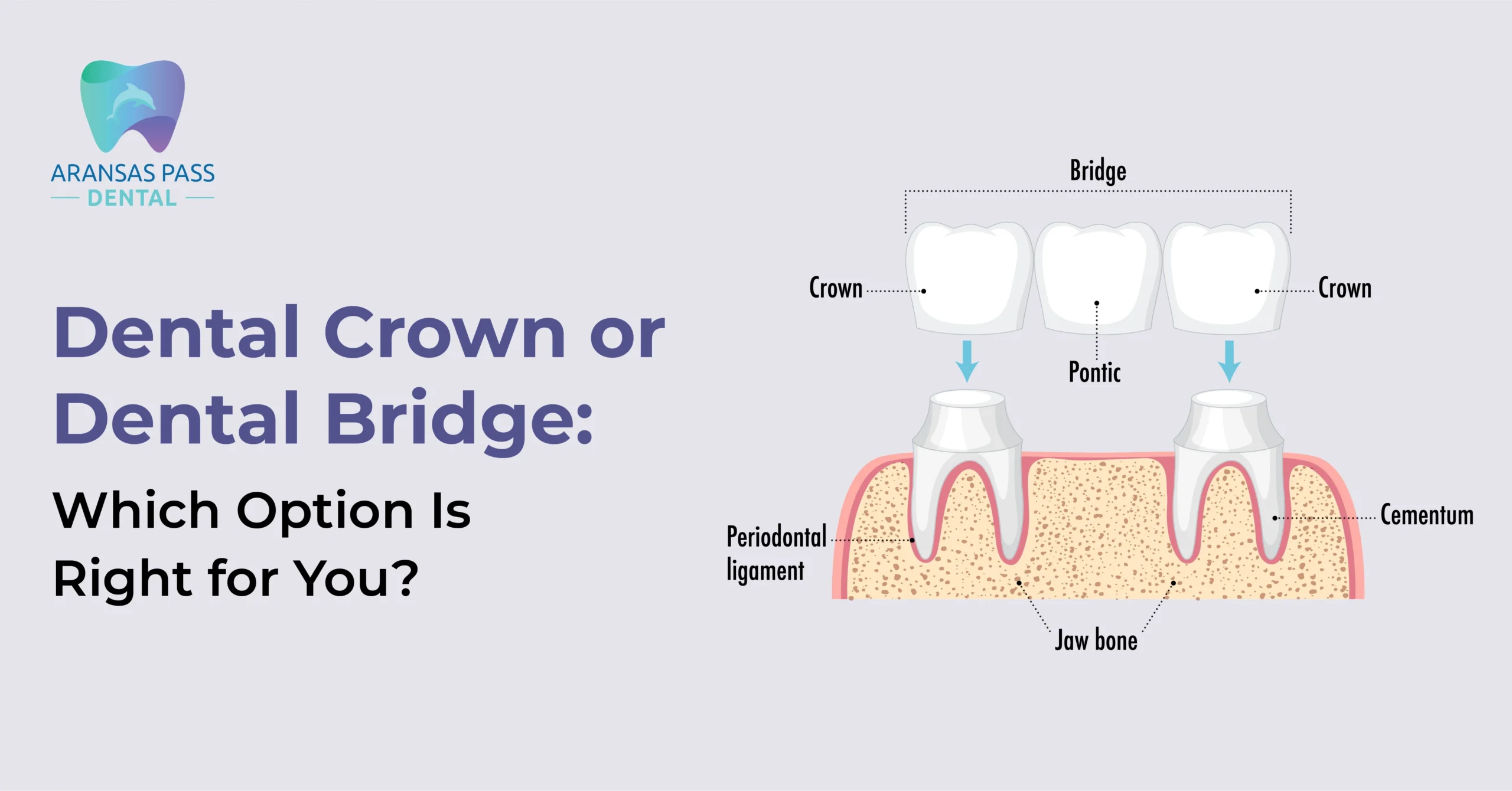 dental-crown-vs-dental-bridge