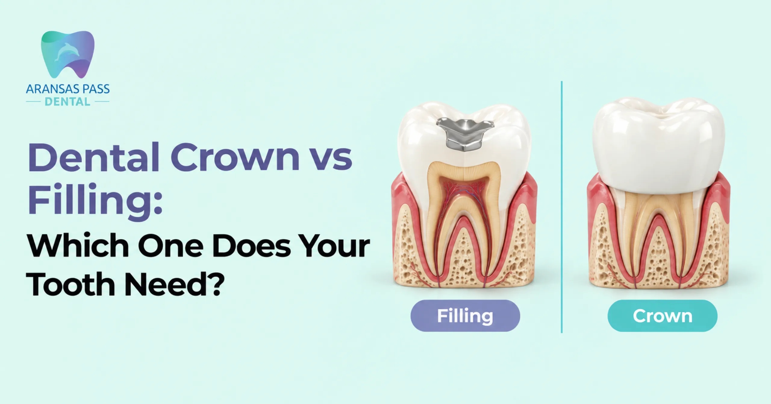 Dental Crown vs Filling Which One Does Your Tooth Need